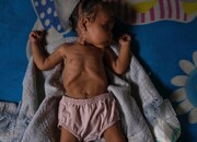 شیوع سوءتغذیه در بین کودکان ونزوئلایی