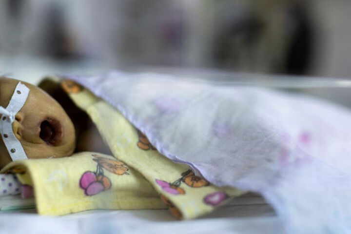 فروپاشی سیستم سلامت افغانستان در بیمارستان اطفال کابل