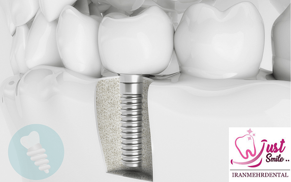 با ۳ سرویس محبوب کلینیک های دندانپزشکی (ایمپلنت، لمینت و کامپوزیت) بیشتر آشنا شوید