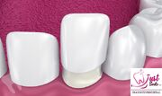 با ۳ سرویس محبوب کلینیک های دندانپزشکی (ایمپلنت، لمینت و کامپوزیت) بیشتر آشنا شوید