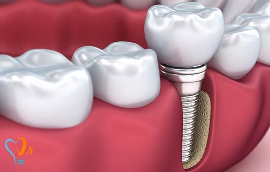 آیا روکش ایمپلنت درد دارد؟