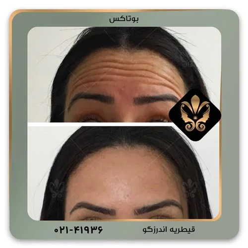 در مورد برندهای بوتاکس ایرانی چه میدانید ؟