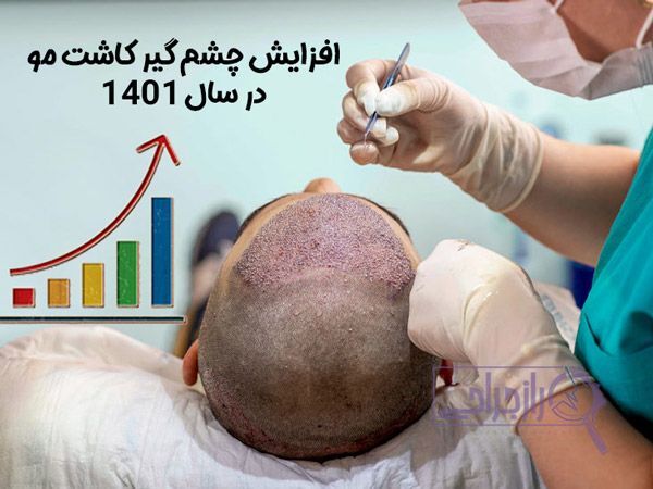 افزایش چشم گیر کاشت مو در سال ۱۴۰۱
