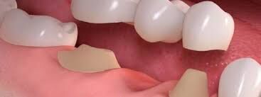 نکات مراقبت بعد از روکش ایمپلنت