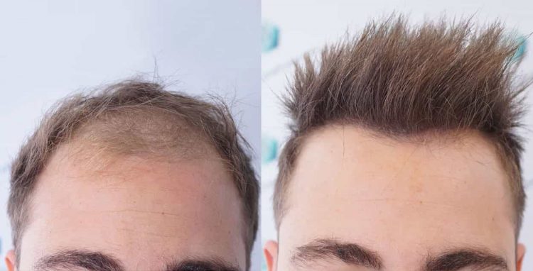 نمونه کاشت مو جدید