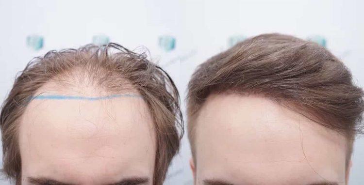 نمونه کاشت موی طبیعی