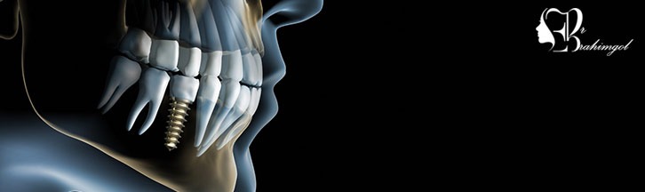 ایمپلنت دندان لیزری