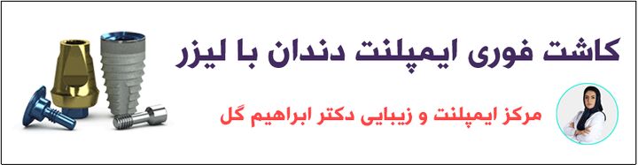 نقش لیزر در کاشت ایمپلنت دندان و جراحی لثه نقش لیزر در کاشت ایمپلنت دندان و جراحی لثه