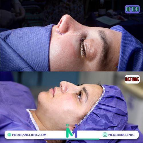 rhinoplasty-05.jpg