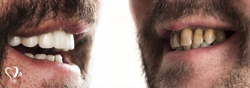 روش های مراقبت از دندان ها