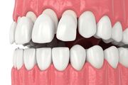 انواع روکش دندان و مقایسه آنها با دیگر روش‌های درمانی