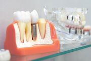 روش نگهداری و مراقبت از ایمپلنت دندان