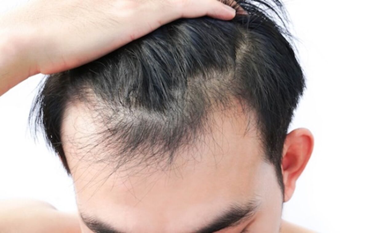 هزینه درمان ریزش مو: از داروها تا جراحی