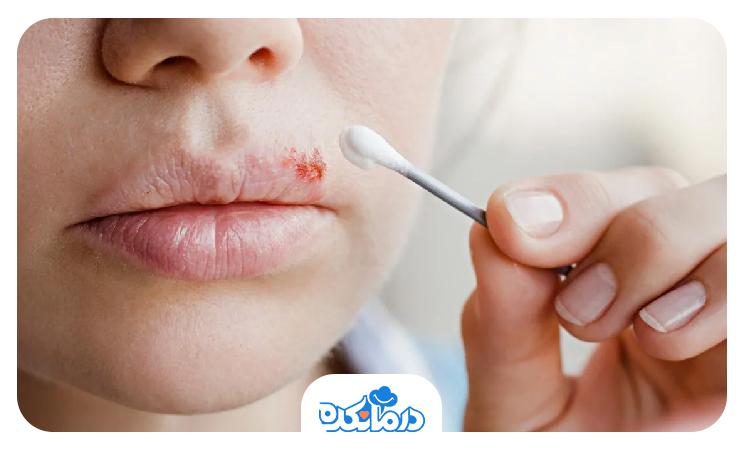 تصویر خانمی که درمان خانگی تبخال را دنبال میکند
