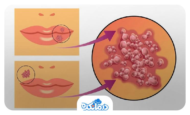 تصویر گرافیکی تشکیل تبخال دور لبها