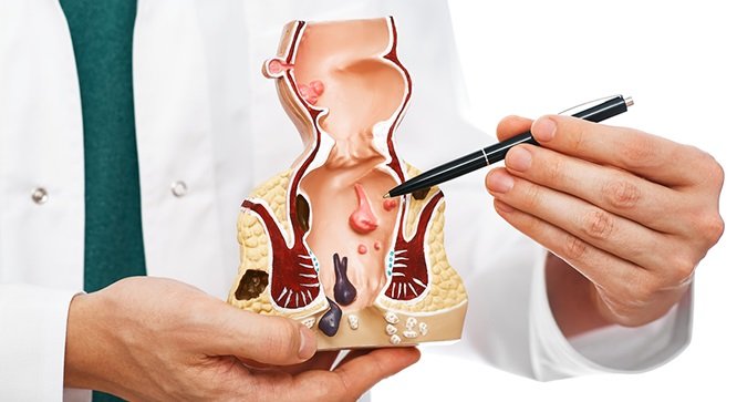 بهترین درمان شقاق را از نظر متخصصین بخوانید!
