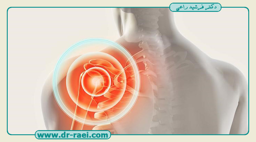 مزایا عمل آرتروسکوپی شانه نسبت به عمل باز