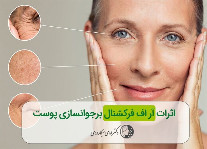 اثرات آر اف فرکشنال و سایر روش های درمانی بر جوانسازی پوست اثرات آر اف فرکشنال و سایر روش های درمانی بر جوانسازی پوست