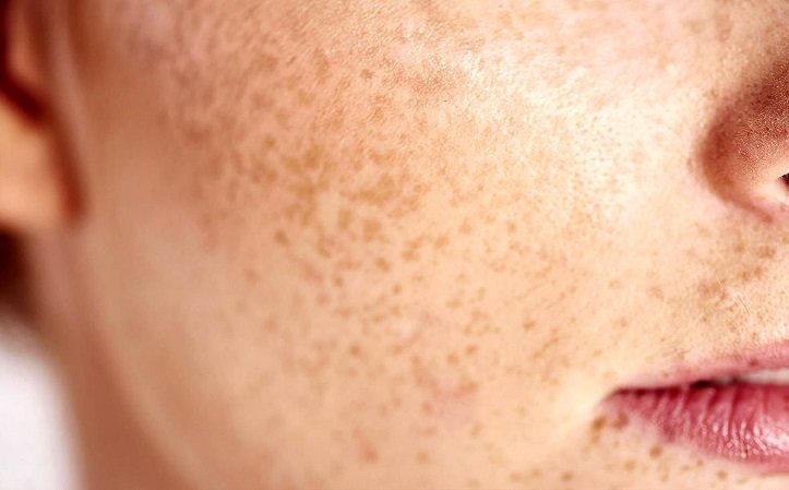 پیشگیری از بروز لک‌های پوستی
