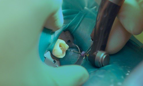 قیمت عصب کشی دندان و عوامل تاثیر گذار در هزینه آن