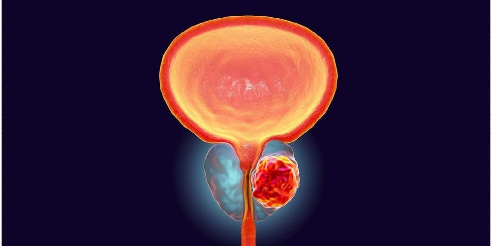درمان پروستات