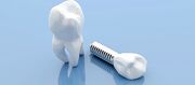 لمینت دندان بهتر است یا ایمپلنت دندان؟
