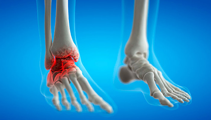 چه زمانی جهت درمان آرتروز مچ پا نیاز به جراحی است؟