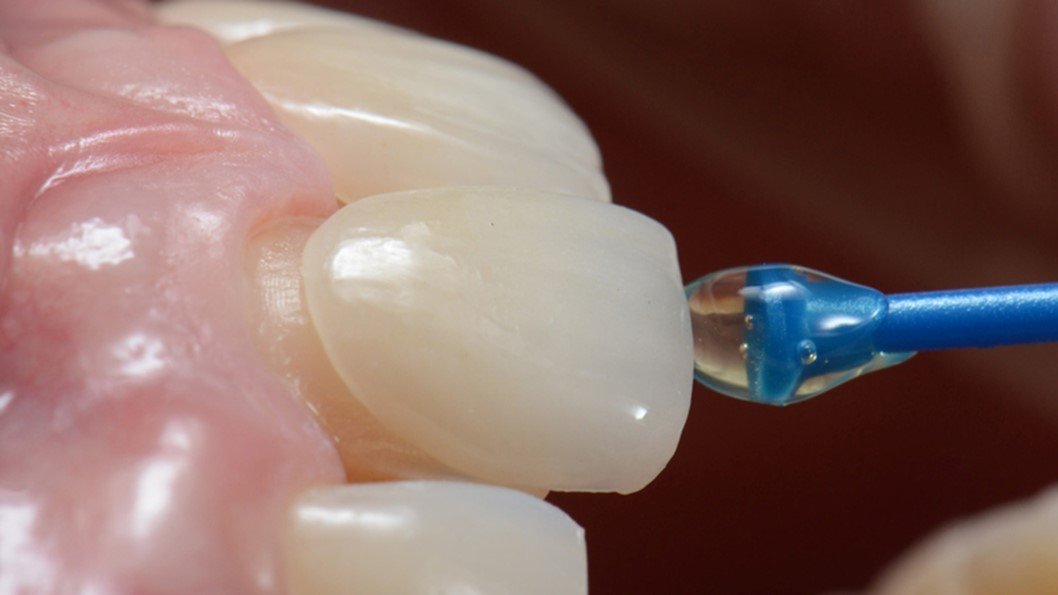 بلیچینگ دندان