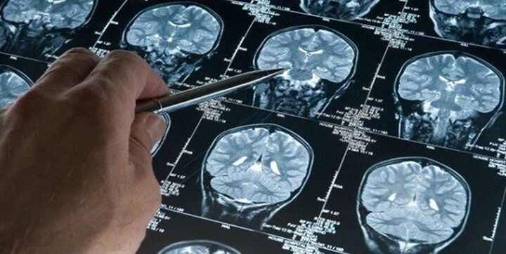 راه‌اندازی خط تولید داروی درمان اولیه سکته مغزی با دانش بومی