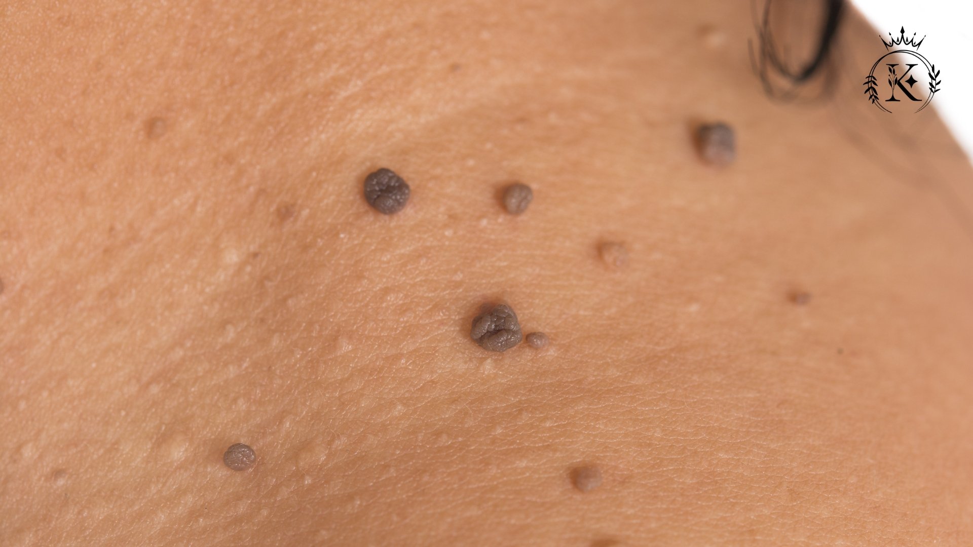 درمان زگیل صورت در خانه