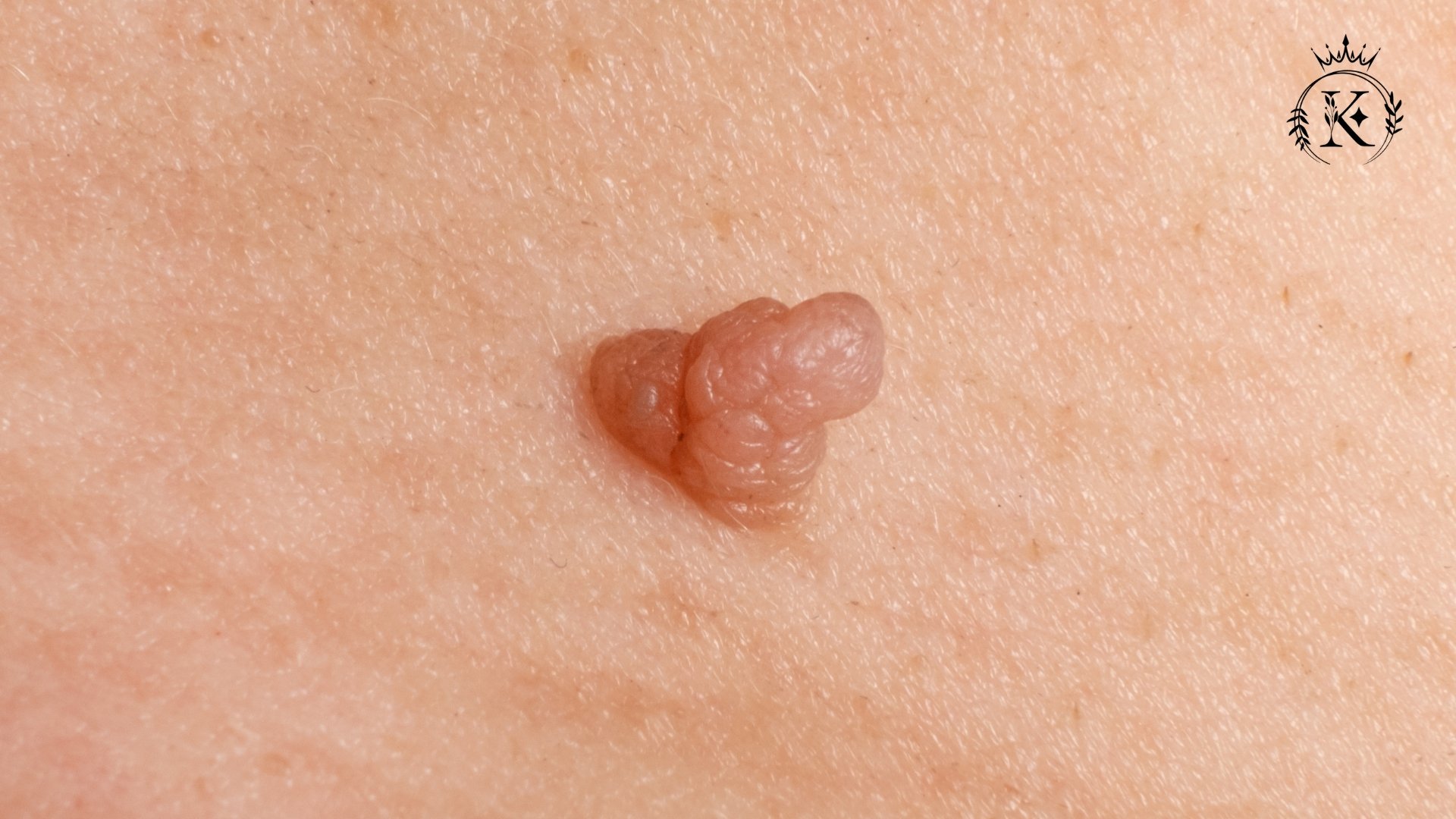 برداشتن زگیل