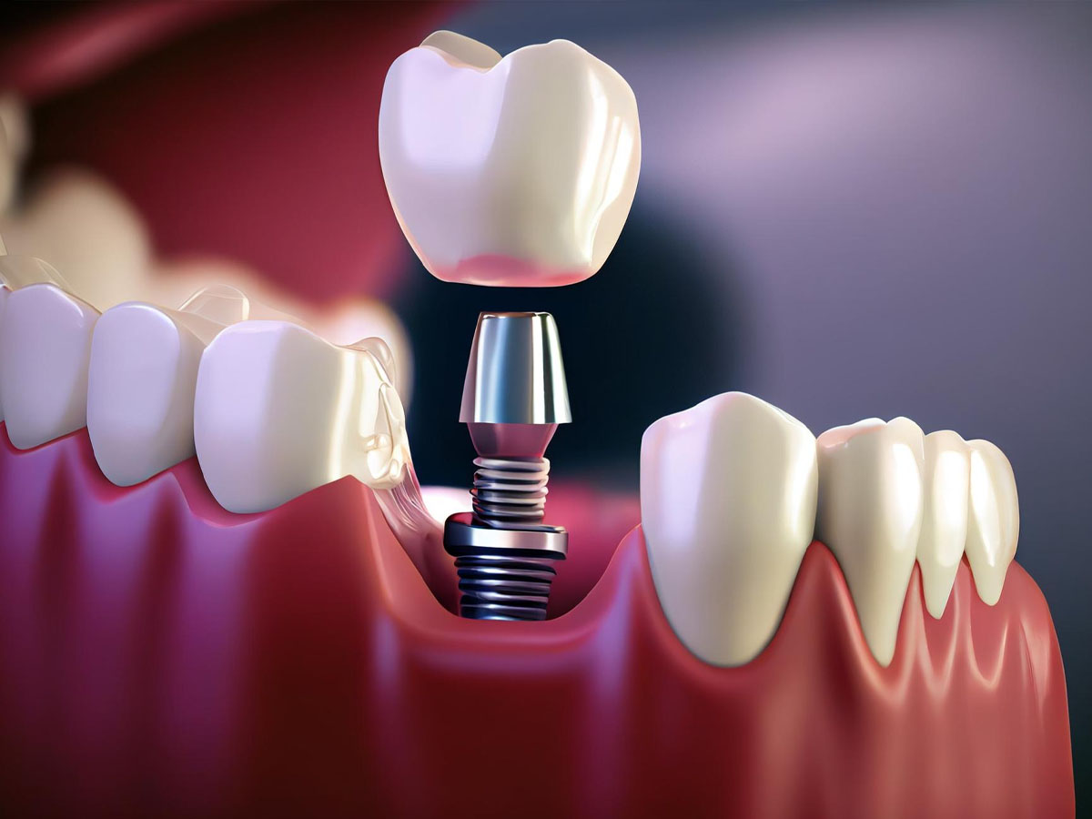 همه چیز در مورد سینوس لیفت در ایمپلنت دندان شامل هزینه و مراحل و مراقبت ها