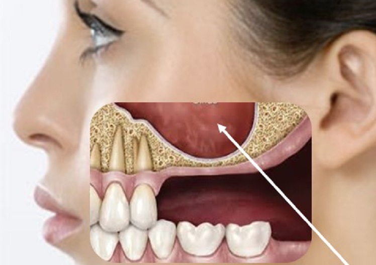 همه چیز در مورد سینوس لیفت در ایمپلنت دندان شامل هزینه و مراحل و مراقبت ها