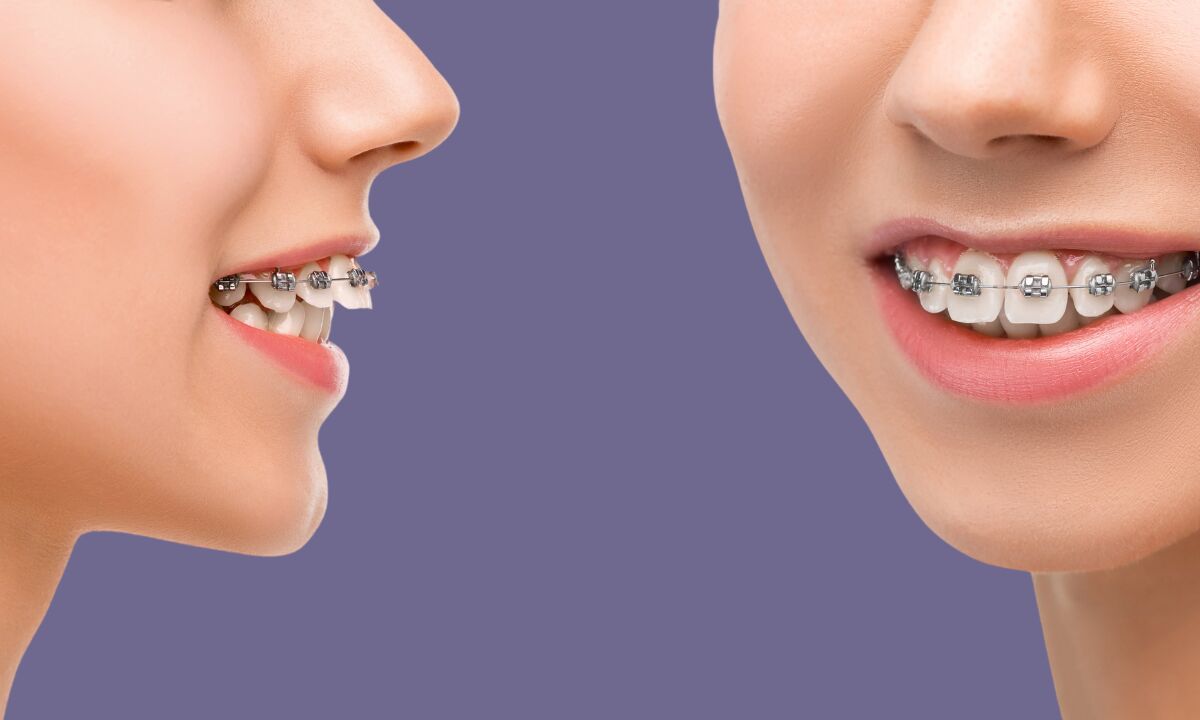 مقایسه هزینه های ارتودنسی سنتی و ارتودنسی نامرئی: کدام گزینه مناسب تر است؟