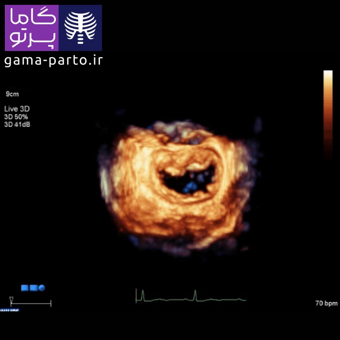 اکوکاردیوگرافی سه بعدی - گاما پرتو