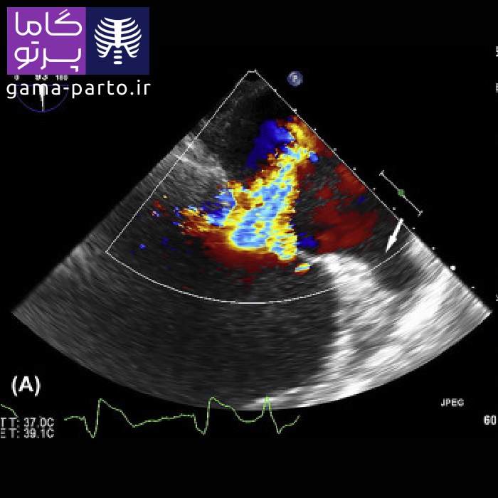 اکو قلب داپلر رنگی - گاما پرتو