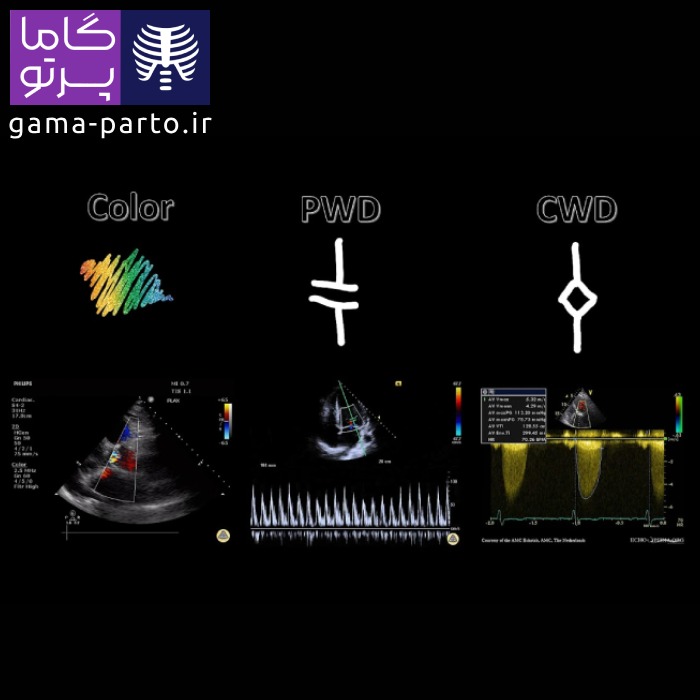 اکوکاردیوگرافی داپلر طیفی - گاما پرتو