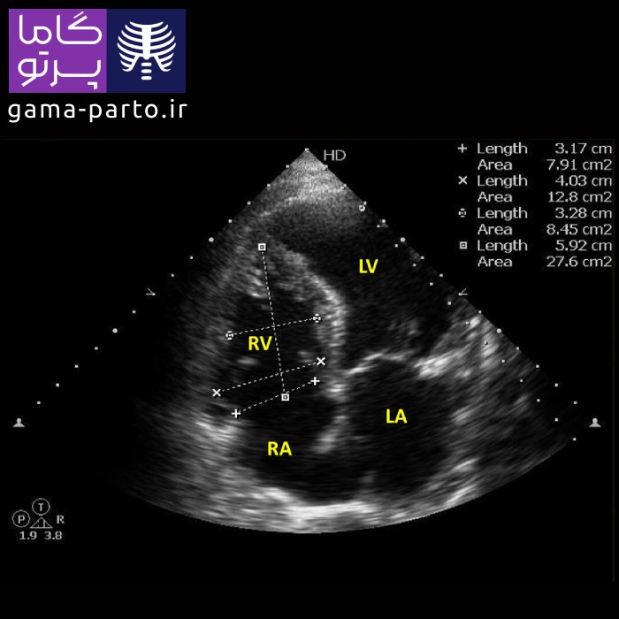 اکوکاردیوگرافی دو بعدی - گاما پرتو