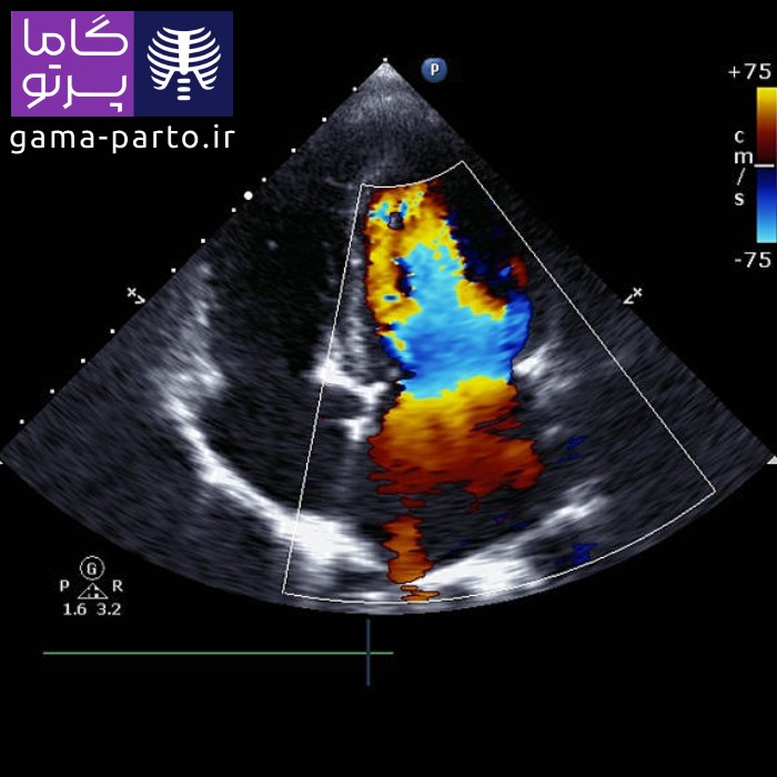 اکو قلب داپلر - گاما پرتو