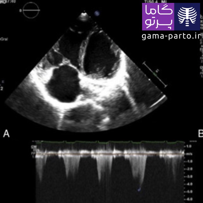 اکوکاردیوگرافی قفسه‌ای (ترانس توراسیک) - گاما پرتو