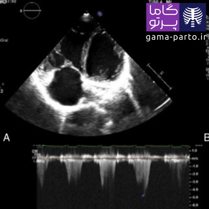 اکوکاردیوگرافی قفسهای (ترانس توراسیک) - گاما پرتو