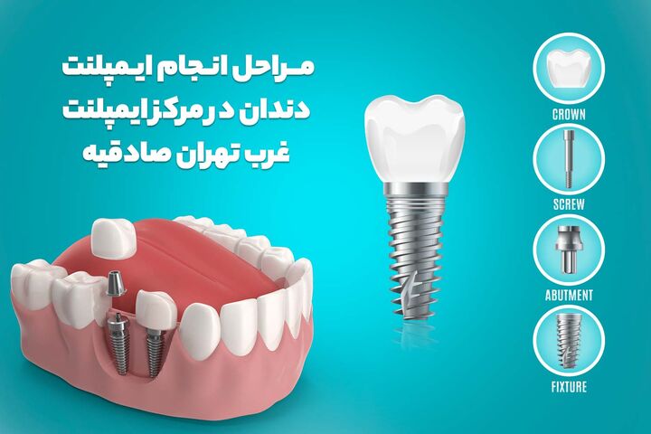 بهترین مرکز ایمپلنت در آیت الله کاشانی (ایمپلنت در صادقیه، غرب تهران) بهترین مرکز ایمپلنت در آیت الله کاشانی (ایمپلنت در صادقیه، غرب تهران)