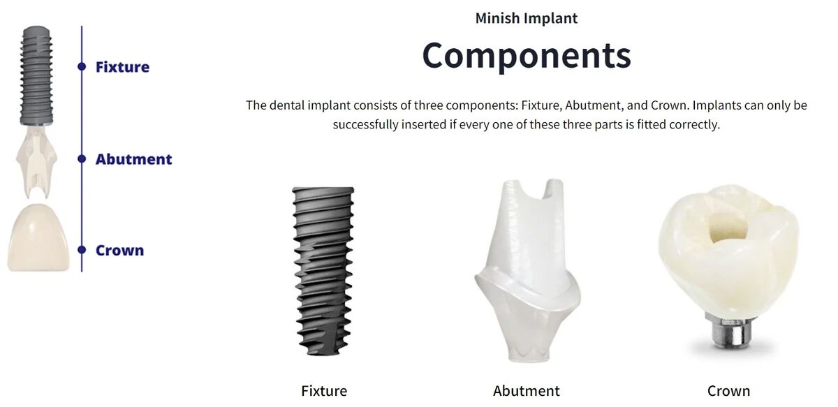 قیمت ایمپلنت کره ای ۱۴۰۴