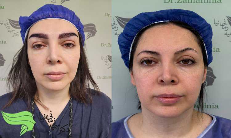 نمونه کار پزشک متخصص برای کاشت ابرو