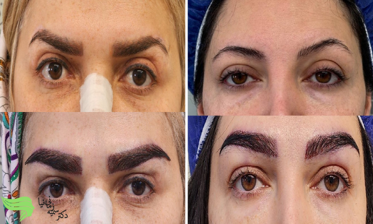انتخاب پزشک متخصص برای کاشت ابرو