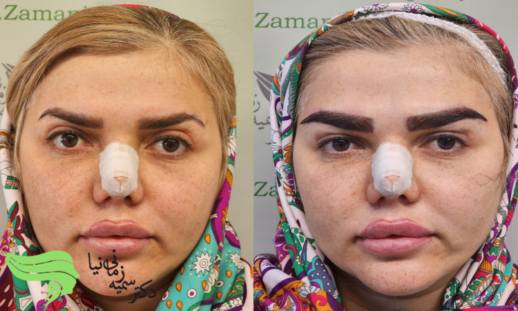 پزشک متخصص برای کاشت ابرو