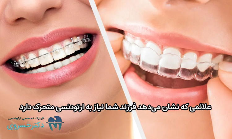 علائم تعیین کننده نیاز کودک به ارتودنسی متحرک