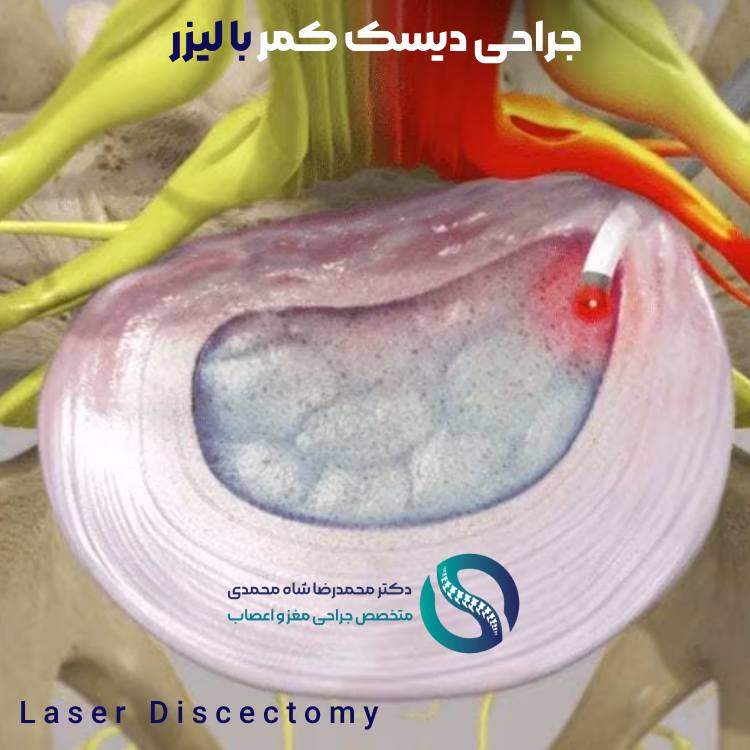 عمل جراحی دیسک کمر با لیزر - دکتر محمدرضا شاه محمدی