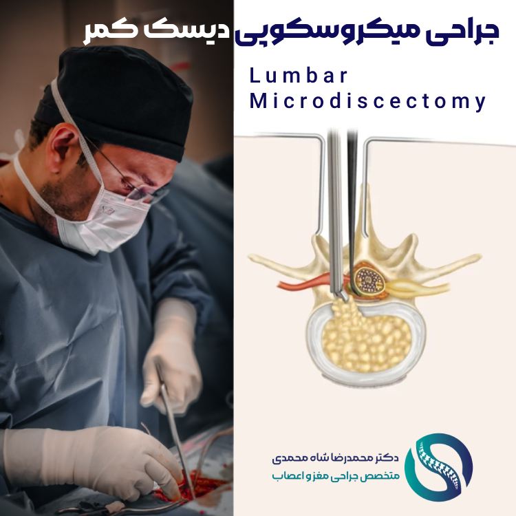 جراحی میکروسکوپی دیسک کمر - دکتر محمدرضا شاه محمدی