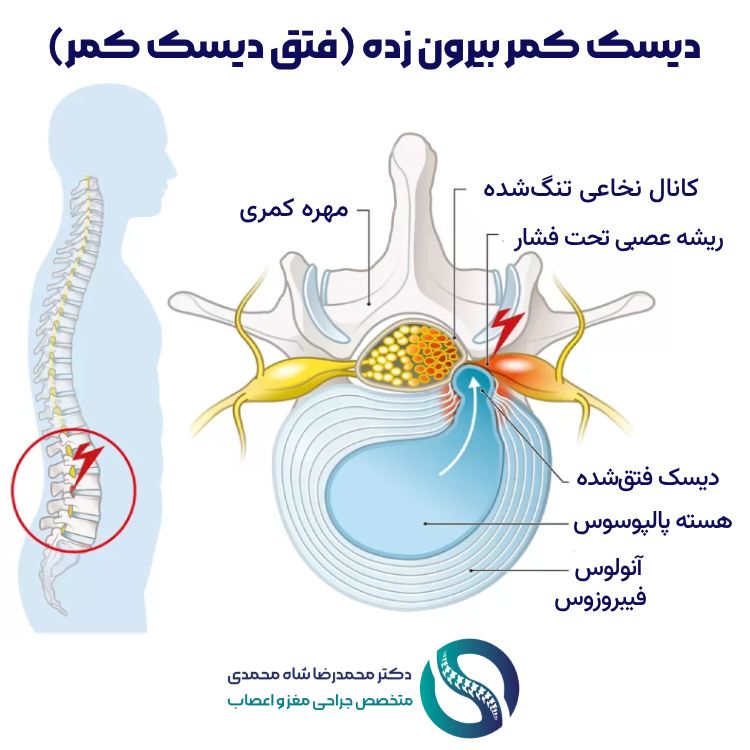 دیسک کمر - دکتر محمدرضا شاه محمدی